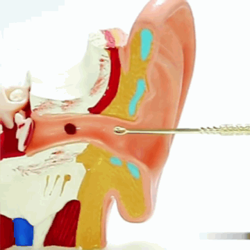 Limpiador de Oídos Innovador