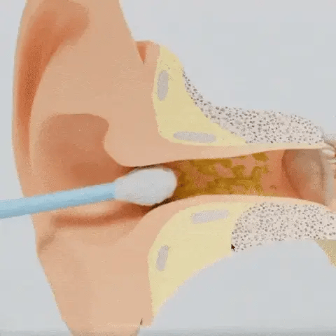 Limpiador de Oídos Innovador